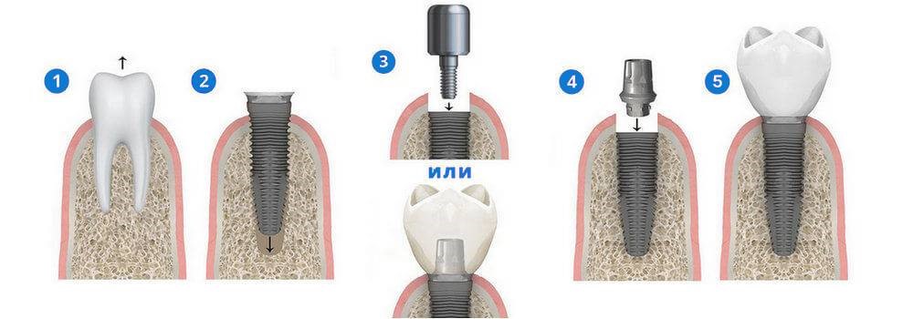 Этапы одномоментной имплантации зубов